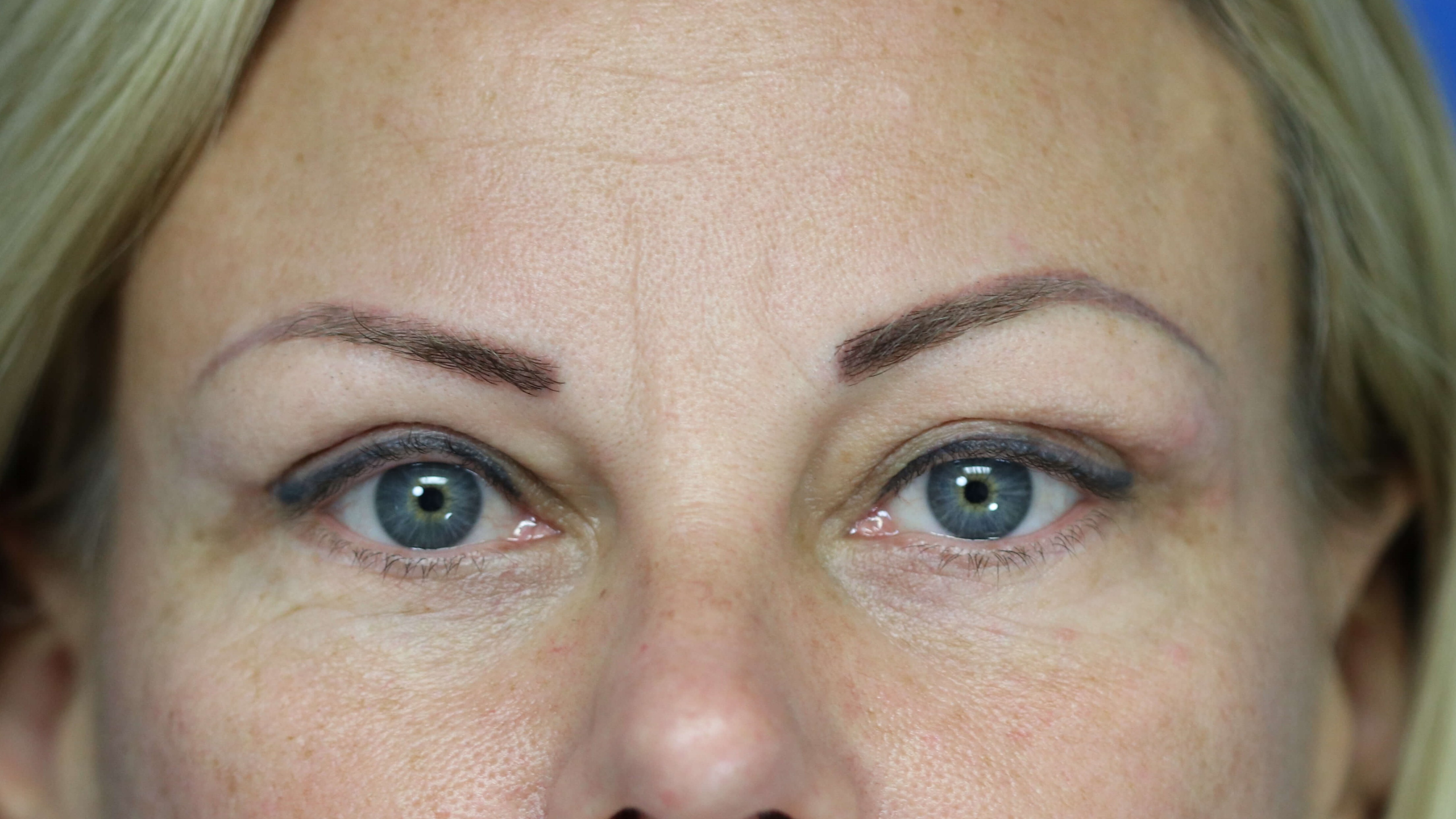 Restoration of upper eyelid sy